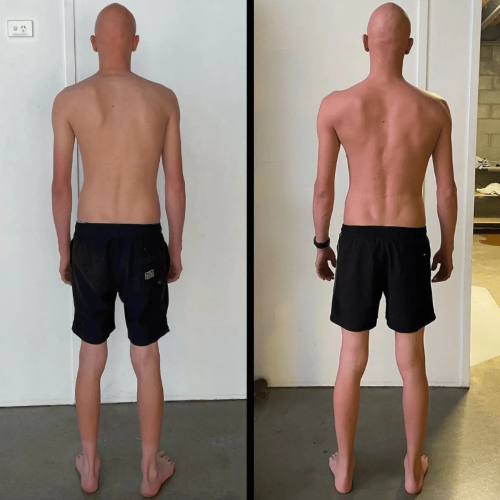 Before and after photos of a client's back with scoliosis